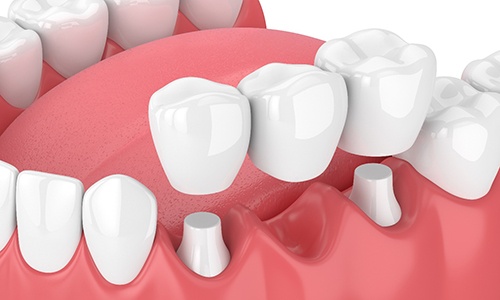 dental professional adjusting a bridge on a model of teeth