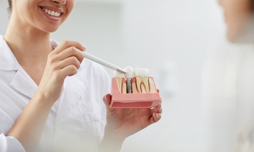 dentist showing a patient a dental implant model