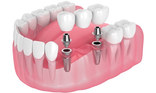 three dental implants supporting a dental bridge