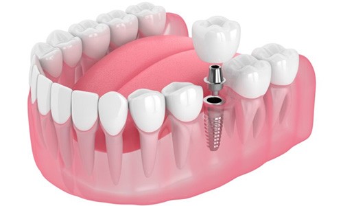 single dental implant with a crown