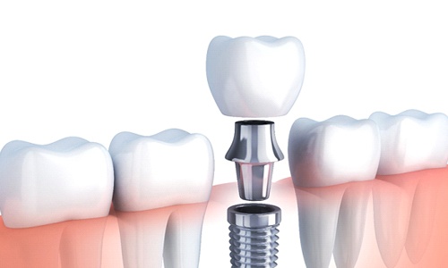 Diagram of a dental implant in Big Pine Key