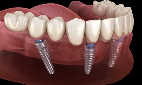 implant-retained denture on bottom arch 