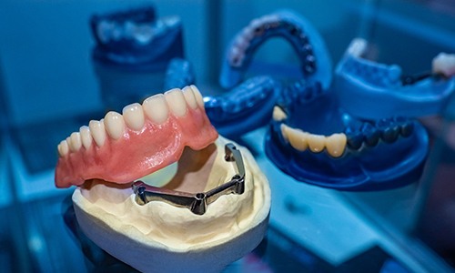implant dentures in Big Pine Key