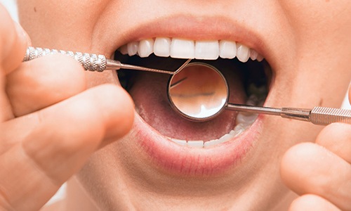 Closeup of patient with tooth-colored fillings near Marathon 