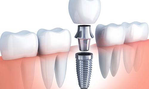 Diagram showing parts of dental implants in Big Pine Key