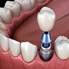 Animation of implant supported dental crown