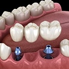 Animation of implant supported fixed bridge