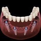 Animation of implant supported denture