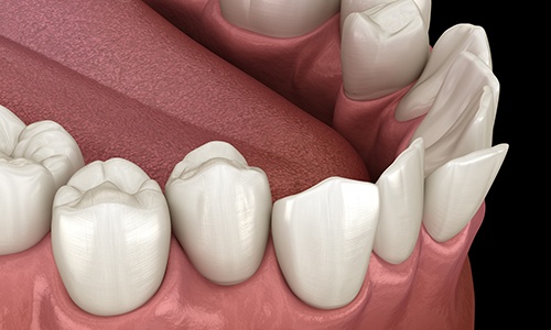 Illustration of crowded teeth