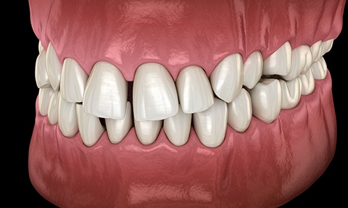 Illustration of gapped teeth