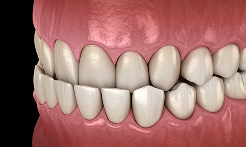 Illustration of an underbite
