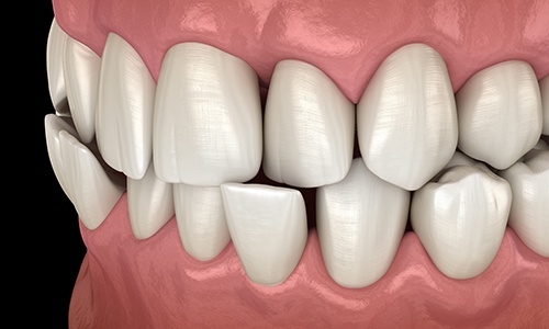 Illustration of a crossbite