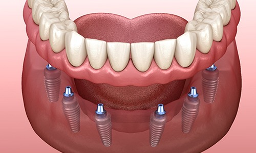 Illustration of implant-retained dentures