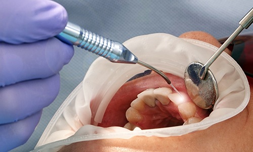 Dentist adjusting dental laser 