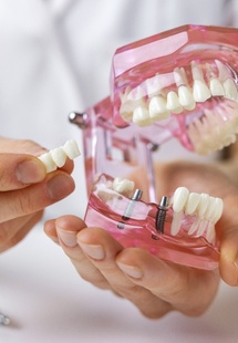 Hands holding model dental bridge and model jaw with implants