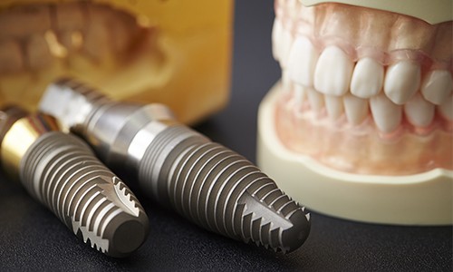 Two dental implants and model smile