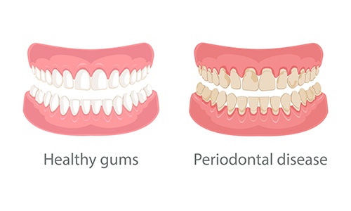 Illustration showing healthy gums vs. gum disease