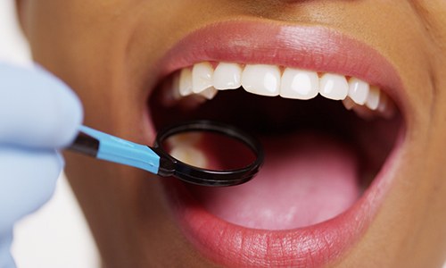 Closeup of patient visiting their Big Pine Key emergency dentist for checkup