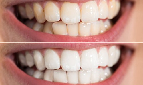 Patient's teeth before and after teeth whitening