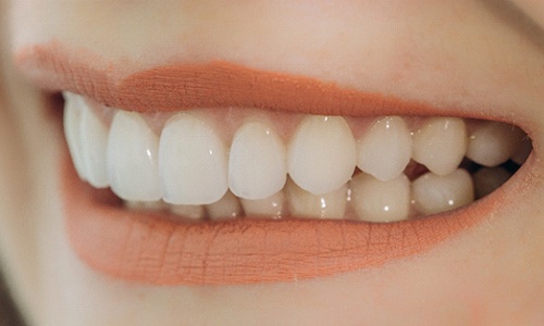 Closeup of woman smiling with veneers in Big Pine Key