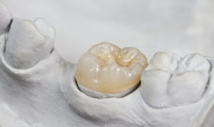 new dental crowns in Big Pine Key