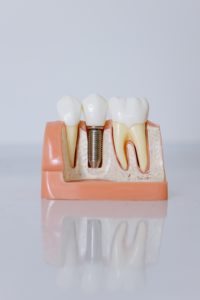Model showing types of dental implants