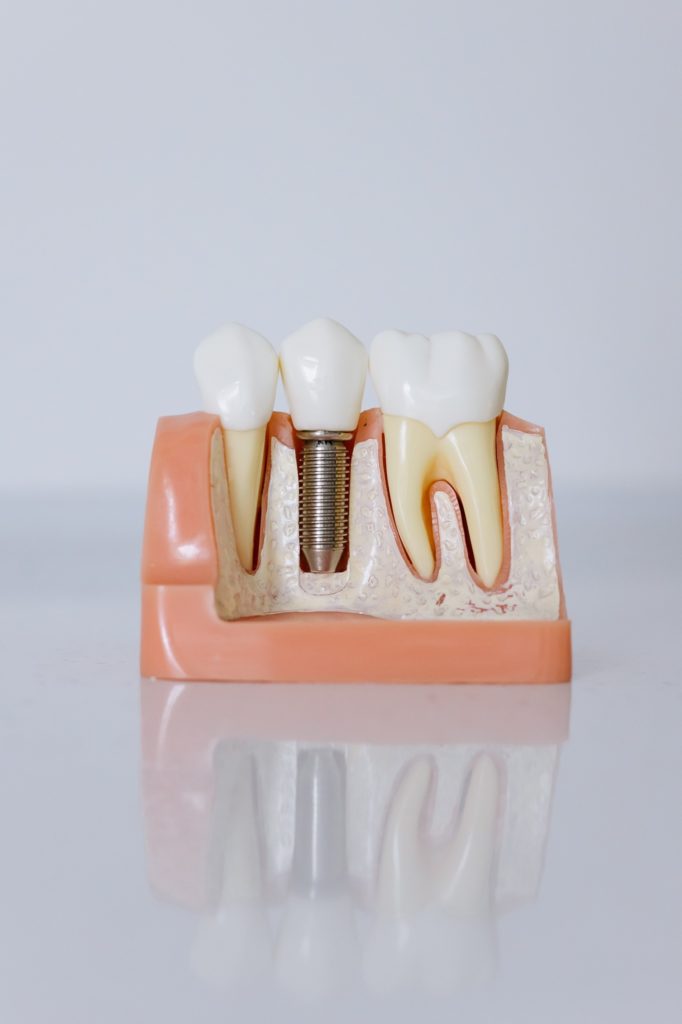 dental implants big pine key Archives Cosmetic & Restorative Dentistry of the Keys Blog