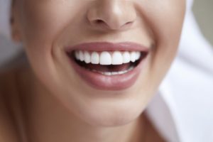 Woman with porcelain veneers