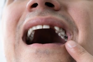 a man showing his missing tooth