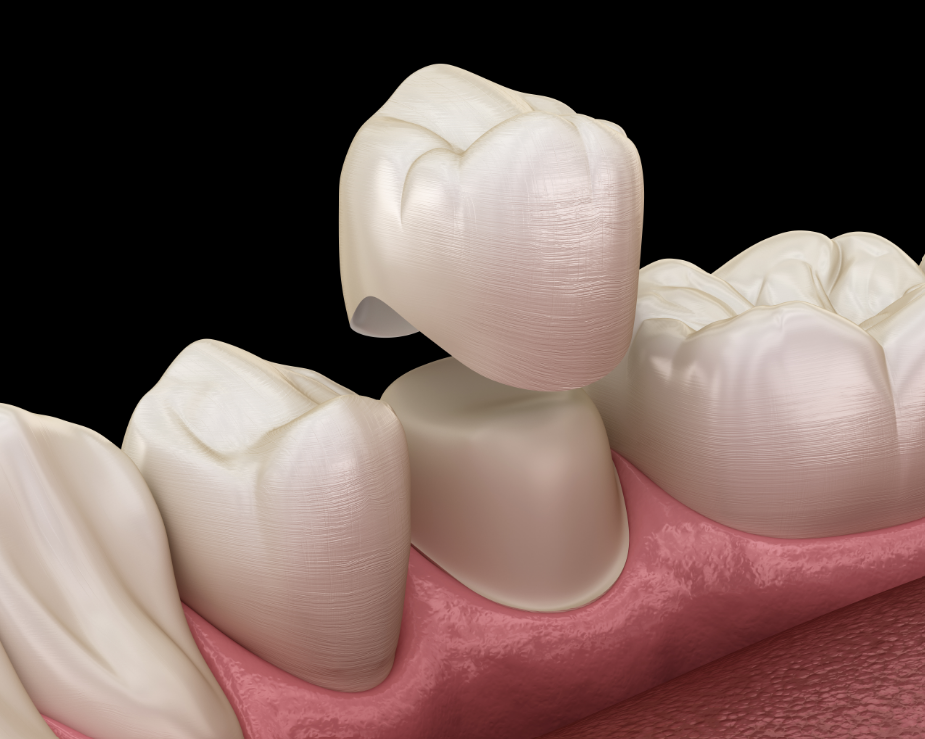 3D image of a dental crown