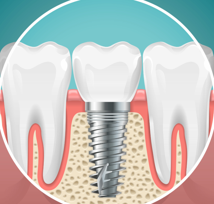 Illustrated cross section of a dental implant