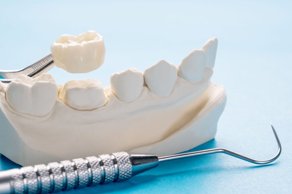 Tweezers placing dental crown over worn-down model tooth