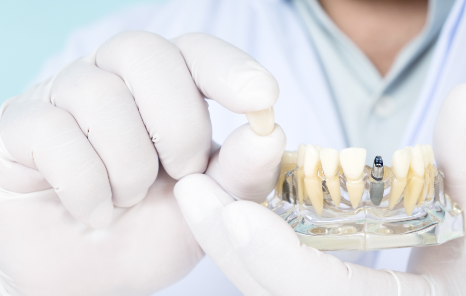 Dentist holding model dental crown